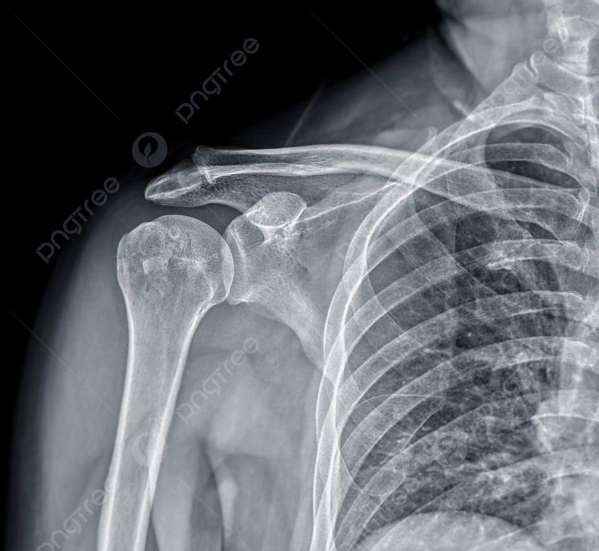 🎯 عند حدوث اصابة في الكتف لاتترك الحادث بدون تشخيص دقيق!
تلعب الأشعة الرقمية DR دور مهم وأساسي في كشف وتشخيص إصابات الكتف بسرعة ووضوح عالي، حتى تساعد الطبيب  في تحديد العلاج المناسب بأقصر وقت 💡
الاشعة الرقمية  DR:-
🔹 تكشف الكسور والخلوع بدقة عالية.
🔹 تساعد بتشخيص التهابات المفاصل والتكلسات.
🔹 تبين مشاكل الأوتار والمفصل بعد السقوط أو الحوادث.
🔹 صور فورية بجودة ممتازة وجرعة إشعاع أقل.
🔹 وقت اقصر لأخذ الاشعة و والتشخيص الدقيق.
♦️ في عيادة العامل للأشعة الرقمية DR
نوفر تصوير رقمي حديث بإشراف كادر متمرس و مختص  واهتمام براحة المراجع 👨‍⚕️✨
📍إذا عندك ألم، سقوط، أو صعوبة بحركة الكتف… لا تهمل التشخيص المبكر.
#عيادة_العامل
#الأشعة_الرقمية
صحتكم.. اهتمامنا
متواجدين طيلة ايام الاسبوع مع يوم الجمعة من الساعة(4-8) مساءً بوجود كادر نسائي متمرس والعيادة طابق ارضي
حي العامل.. السوق الشعبي.. شارع الأطباء.. مجاور صياغة الزيدي.. مقابل مكتب السيد الشهيد محمد صادق الصدر (قدس سره) 
للاستفسار الاتصال على الرقم :***********
