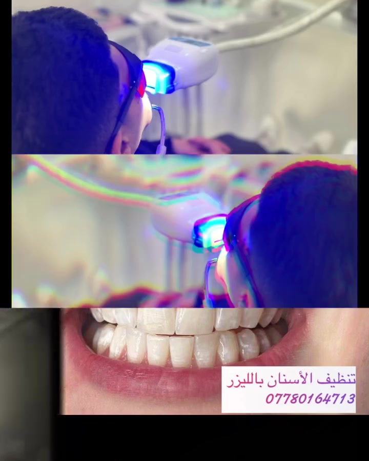 الابتسامة البيضة مو بس جمال… هي ثقة.

وبمناسبة العيد سوّينا عرض خاص على تبييض الأسنان بسعر مناسب
حتى تستقبل العيد بابتسامة تلمع بكل مكان.

✨ فرق واضح من أول جلسة
✨ تبييض آمن بإشراف طبي
✨ ابتسامة تخلي صور العيد غير

خلي ابتسامتك تحچي عنك قبل الكلام.

📩 احجز هسه قبل لا تخلص المواعيد.
***********
#exploremore #اكسبلور #explore
#تبييض_اسنان
