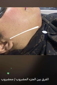 ليزر ازاله شعر الوجه بجهاز كانديلا العبيدي بنايه المجلس البلدي القديم ...