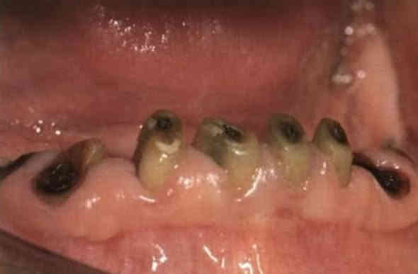 💕السلام عليكم يتوفر علاج مجاني للأسنان  💕

🦷 حشوات ضوئية تجميلية

🦷 حشوات جذور

🦷 قلع الأسنان التالفة وسن العقل والحذور المتبقية

🪥 تنظيف الأسنان من التصبغات والتكلسات

🦷 تعويض الأسنان المفقودة

🦷 جلسة فلورايد للأطفال لوقاية مينا الأسنان

🦷 قلع أسنان الأطفال وحشوات تجميلية للأطفال

🤍 كلشي مجاني: الفحص + الأشعة + متابعة الحالة

📩 للحجز والاستفسار راسلوني خاص او على الرقم ***********

📍العنوان:الجبيلة عيادات كلية طب الأسنان جامعة الكنوز
