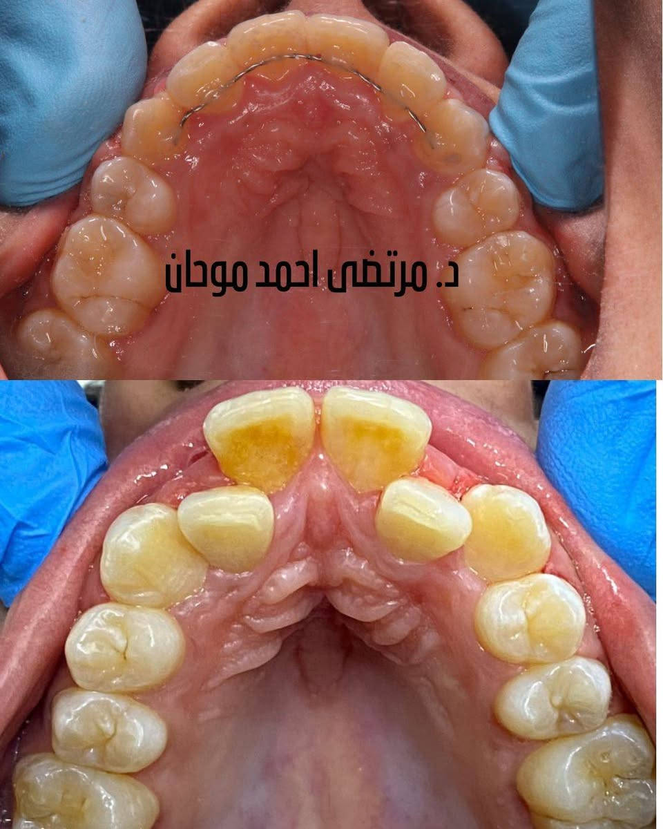 تعديل تراكب وتزاحم الاسنان بواسطة التقويم المعدني من شركة دنتارم تمت الحالة خلال سنة وشهرين فقط
الحمدالله حصلنا نتيجة ممتازة ومرضية للمراجعة
طبيب تقويم الأسنان مرتضى أحمد موحان
للحجز واتساب ***********
تكدر تزورنا ونفحص اسنانك تحتاج تقويم او لا
معاينةالتقويم مجاني
فرع شيخ صاحب مجمع علي تركي
الطابق الثاني
