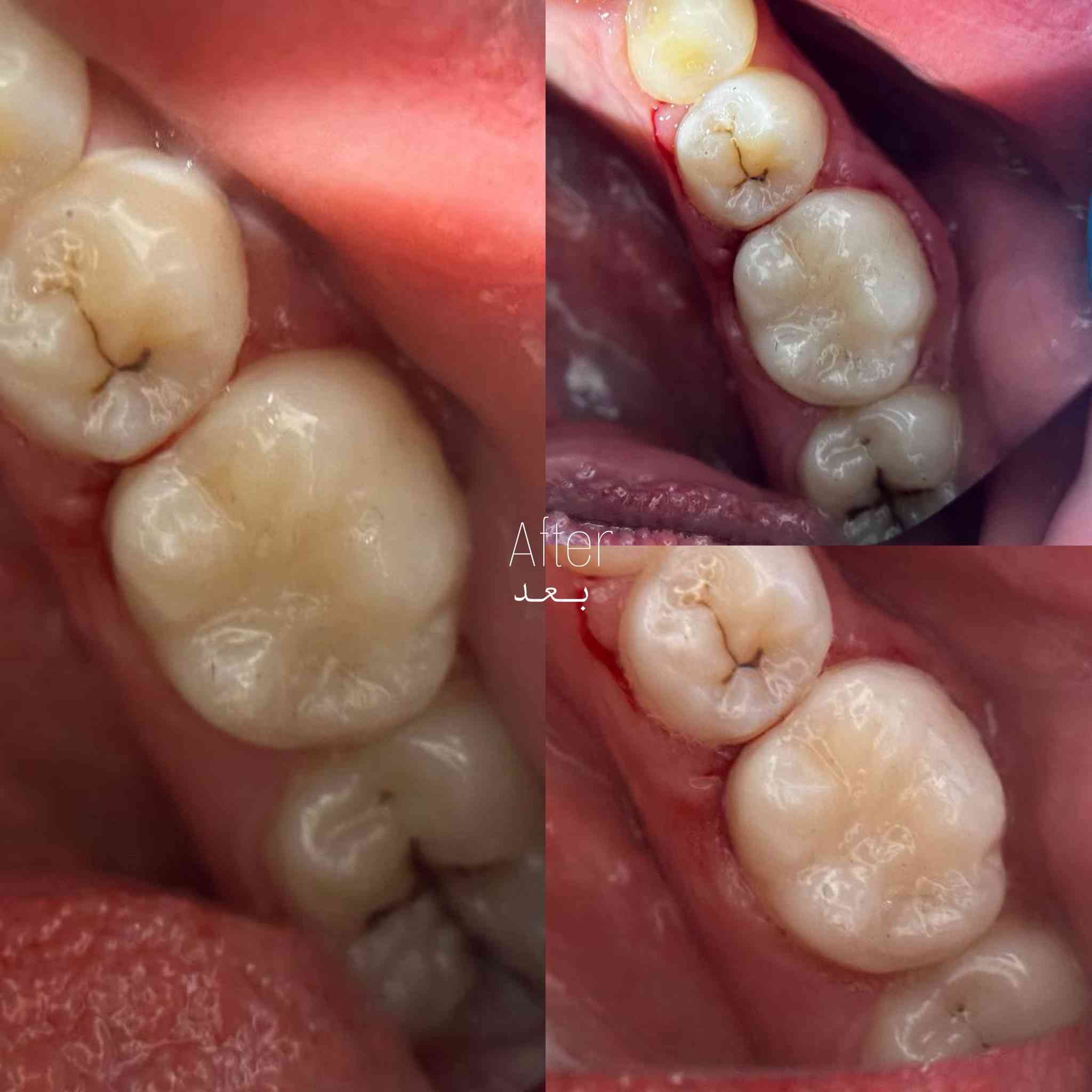 السلام عليكم ورحمة اللّٰه وبركاته 🦷🪥
الى كل من يحتاج رعاية طبية لأسنانه وذلك من

🔴حشوات تجميلية بيضاء
🔴حشوات جذور
🔴قلع الاسنان التالفة او الجذور المتبقية
🔴تنطيف التكلسات القوية
🔴قلع أسنان الاطفال
🔴تقويم أسنان للاطفال
جميع هذه الخدمات متوفرة في العيادات التعليمية لجامعة ذي قار علماً بأن العلاج مجاني ماعدا تكلفة الباص .
وهذه بعض من الحالات التي تم علاجها على يد 
الدكتورة: غدير جاسم محمد / المرحلة الخامسة
العنوان: حي اور / كلية طب الاسنان مقابل مستشفى الحسين التعليمي فرع الطب العدلي
للحجز: التواصل على الخاص او الرقم *********** او على حساب الانستكرام
gh_clinic0
