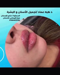 فيلر شفة • طبيعية • تدوم سنة