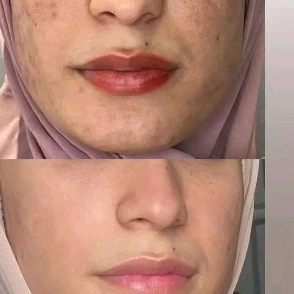 خلطاتي علاج للبشره مضمونه ومجربه تسوي وجهج كيمر تزيل الكلف وتصبغات الوجه تعطي نظاره وحيويه للوجه تعالج تجاعيد الظاهره للوجه تستخدم لمعالجة تغليل النمش خلطاتي تغنيج عن ابرالنظاره وقيرها تلاحظين الفرق من اول ستخدام تبييض الوجه توحيدلون البشره تستخدم لمعالجة حب الشباب تستخدم
ملاحظه الخلطات تستخدم لرجال والنساء الخلطه ب 10وتوصيل مجاني
متوفرتوصيل لباب البيت


**إذا كنت صاحب هذا الإعلان وتريد حذفه لأي سبب، رجاءا أرسل رسالة إلى الدعم الفني**