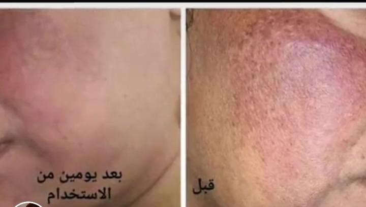 بكج مبيض للبشره والجسم سعر ٣٠ الف


**إذا كنت صاحب هذا الإعلان وتريد حذفه لأي سبب، رجاءا أرسل رسالة إلى الدعم الفني**