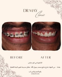 إذا عندك اسنانك مخربطةو متردد تبدي تقويم، نصيحتي لا تأجل الموضوع أكثر....