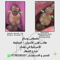 🦷 فرصة علاج الأسنان في عيادات الجامعة الأمريكية في بغداد العلاج يتم تح...