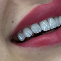 جمال أسنان • تغليف أسنان • تركيبات أسنان • ابتسامة هوليود • عيادة أسنا...