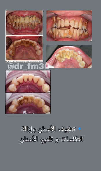 حشوات الاسنان الأمامية و تنظيف الاسنان مجاناً ✨
العلاج بـ جلسة  واحده فقط 🦷🌷
للتواصل ***********
