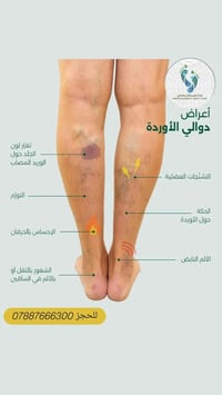 من العلاجات المهمة و المنقذة للقدم للمرضى الي يعانون من دوالي الساقين ...