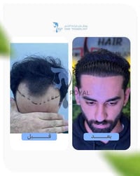 بعد ٩ أشهر من زراعة الشعر… ظهر الفرق الحقيقي. من مرحلة التراجع والخطوط...