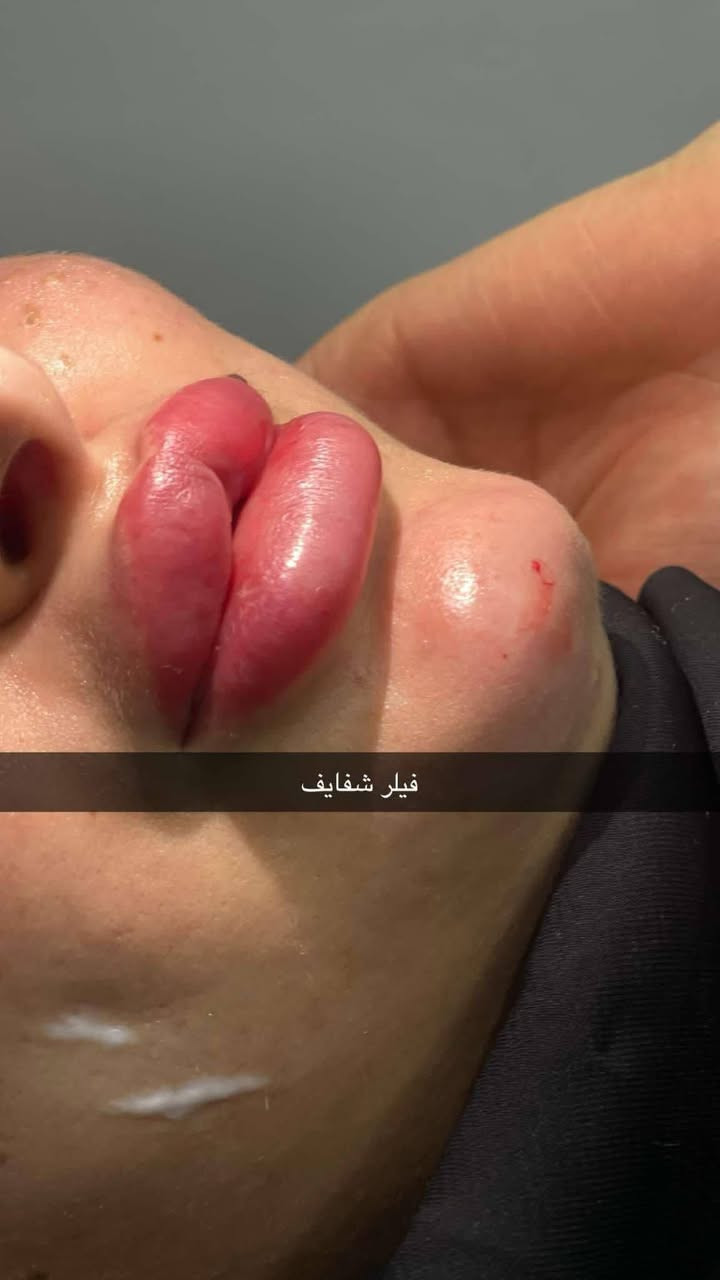 #فيلر_شفايف_بسيط_شغل_الدكتورةصابرين  #فلر_شفايف #عيادة_تجميل #صالون #الروان #العنوان #كربلاء #قنطرة #السلام #الحجزوالاستفسار #على #واتساب***********

متوفر الدفع عن طريق البطاقة المصرفية💳💳
