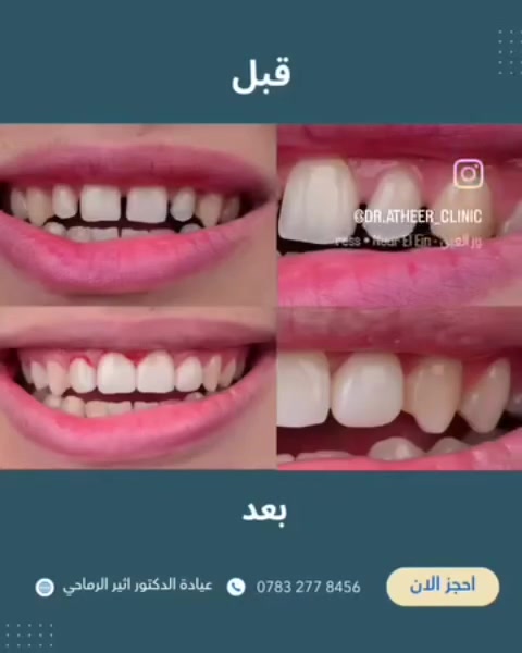 “إعادة بناء وتجميل الأسنان الأمامية… لابتسامة طبيعية ومتناسقة من جديد.”

☎️للحجز والاستفسار ***********

📍الموقع :

الديوانية- قضاء عفك/شارع الأطباء قرب صيدلية أكرم البديري بناية الدكتورة مروة حمود التميمي الطابق الثاني

#ابتسامتك_تستحق_الأفضل
#اكسبلورexplore #قضاء_عفك
#حشوات_تجميلية_للأسنان🦷
