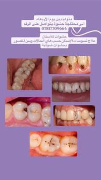 علاج أسنان مجاني • حشوات ضوئية تجميلية • الزبير جامعة المربد