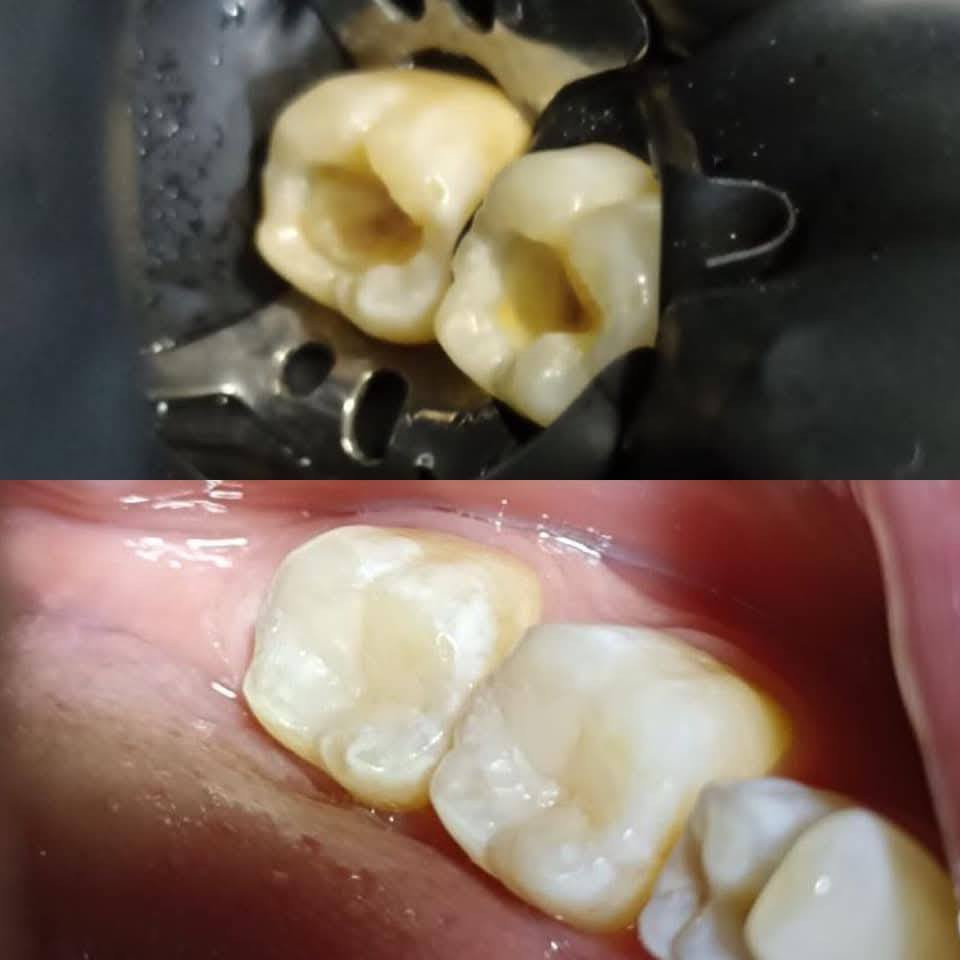 عيادة طب الاسنان الحديثة 
الدكتور علي كاظم رشيد القريشي 
حشوات ضوئية-قلع سن العقل-حشوات جذور
تنظيف و تبييض الاسنان الليزري -تركيب الاسنان الثابتة والمتحركة 
قضاء البدير-شارع الأطباء الطبي(بيت الحاج دريول) خلف مدرسة القاهرة مجاور صيدلية البديرالنموذجيه ***********
عيادة الدكتور علي كاظم القريشي لطب وزراعة وتقويم وتجميل الأسنان @إشارة
