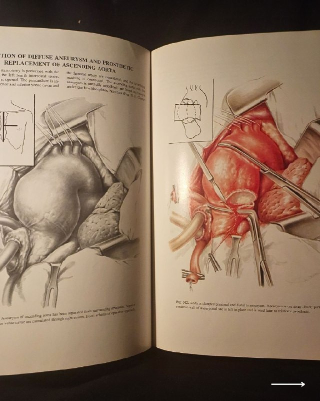 "أطلس جراحي طبي نادر وفخم من روائع الطب السوفيتي الأكاديمي! "
🚩
🫁
🩺
💚
📘
(Atlas of Thoracic Surgery - Volume Two)
المحرر: الأكاديمي بوريس ف. بيتروفسكي (Academician Boris V. Petrovsky).
⚜️
📚
🚩
☭
✨
عن هذه النسخة التراثية:
سنة الطبع: 1979م (طبعة أصلية قديمة ونادرة صادرة عن دور النشر العلمية السوفيتية المترجمة للإنجليزية).
الحالة: ممتازة
✅
⚜️
الموضوع:
أطلس جراحي موسوعي وفخم يتناول جراحة الصدر والأوعية الدموية الكبرى والقلب والرئتين بالتفصيل التشريحي والعملياتي الدقيق، يضم مساهمات كبار علماء الجراحة في الاتحاد السوفيتي السابق، يهم جداً أطباء جراحة الصدر والقلب، طلاب كليات الطب والصيدلة، وهواة اقتناء المراجع الطبية التراثية الأجنبية النادرة.
🔹
السعر: 35 د. ع.
📜
للحجز
🔻
:
البوت:
@PH_900bot
أو واتساب: ***********
