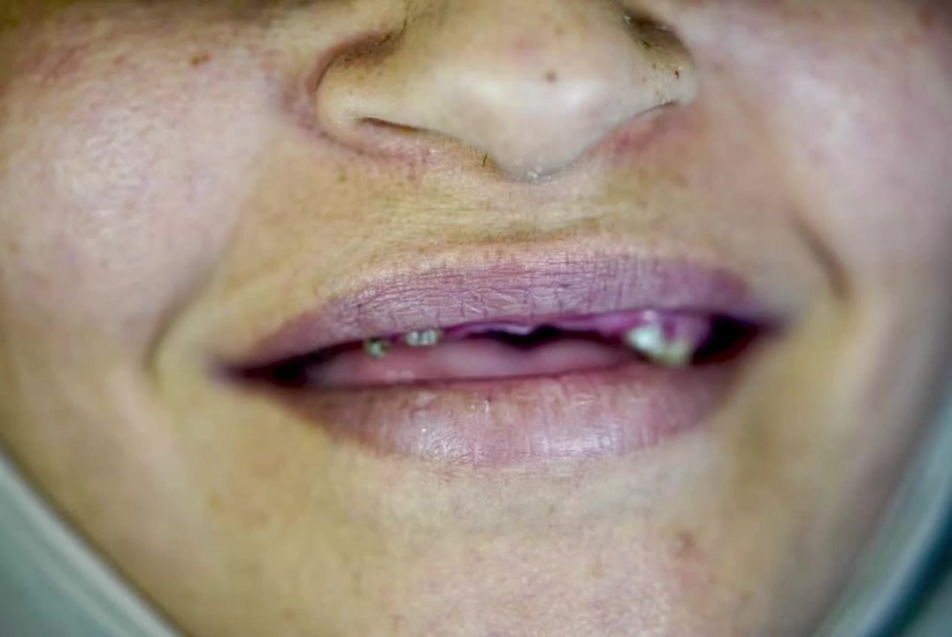 ابتسم دائماً ❤️
الشغل الصح ✅ بالمكان الصح✅🫡

(زراعة-تقويم-تغليف-تركيب)

#ملاحظة ضمان مدى الحياةأدواتنا استخدام واحد فقط

المياه المستخدمة أثناء المعالج معقمة(كاسات) 

للحجز والاستفسار مراسلة الصفحة أو الاتصال على الأرقام التالية ☎️*********** _***********

#اسنان #زراعة #تقويم #تغليف
#المحمودية #بغداد #مدينة_الصدر

تيك توك 👇👇👇
￼https://www.tiktok.com/@mstk520?_t=ZS-8vKXPDhbuIm&_r=1

انستا 👇👇👇
https://www.instagram.com/lmrkzlswryltby/
profilecard/?igsh=Y2d5ODJ5Z3YwNWl3
