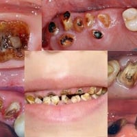 الي محتاج قلع اسنان وجذور متبقيه  الخدمة متوفرة مجاناً.  تحت اشراف اطب...