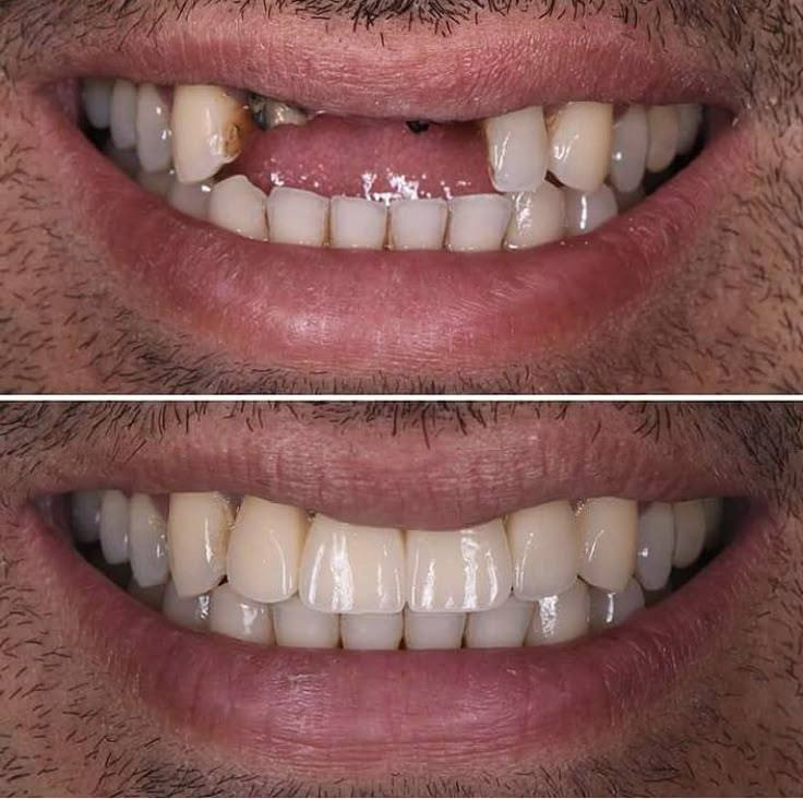 تعويض الاسنان المفقودة بطقم اسنان وكذالك ازالة الجذور التالفة وتعويضها 
الان استعد ابتسامتك وتالقك 
***********
