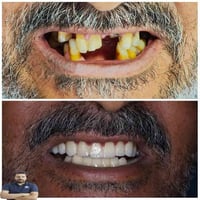 تغليف زركون • زراعات اسنان • المسيب شارع البلدية