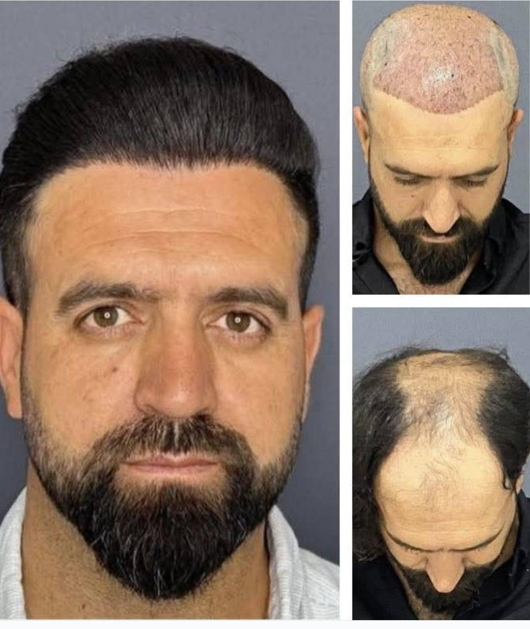 💥احدث تقنيات زراعة الشعر بعيادة بغداد .
💥بأدرة دكتور يونس البديري .

💥زراعة vib كامل التفاصيل علينه.

//للتواصل (***********)واتساب وتصال
