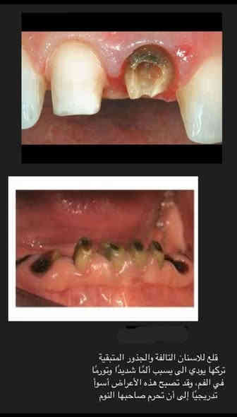 مجاناً ❗ 
- قلع الاسنان او الجذور المتبقيه 
- طقم اسنان ( تعويض الاسنان المفقوده) 
- حشوات ضوئية و معدنيه 
-تنظيف الاسنان و ازاله التكلسات 

علماً أن العلاج مجاني وتحت اشراف أطباء اختصاص
## يتوفر علاج أسنان الاطفال 

العنوان : بغداد- شارع مطار المثنى العسكري-  جامعة آشور- قرب العلاوي
@mohdt2 تلي گرام 
*********** واتساب
