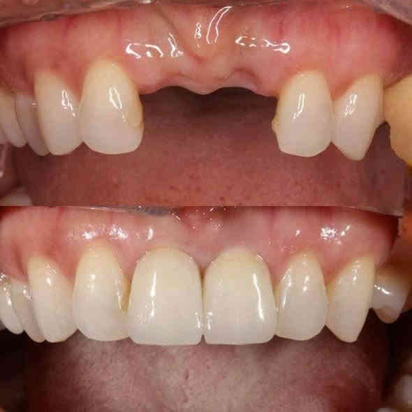 تعلن عيادة إبرو لطب الأسنان وتجميل عن عروض وتخفيضات في قسم الأسنان وتجميل مكان العياده ماجديه نهاية شارع الجامع مقابيل مأكولات البيك ويوجد ايضا ليزر لإزالة الشعر والوشم رقم الحجز ***********
