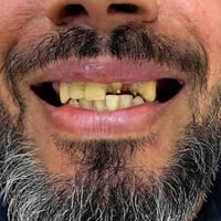 جسر زركون ألماني • ضمان مدى الحياة • عيادة حي النصر