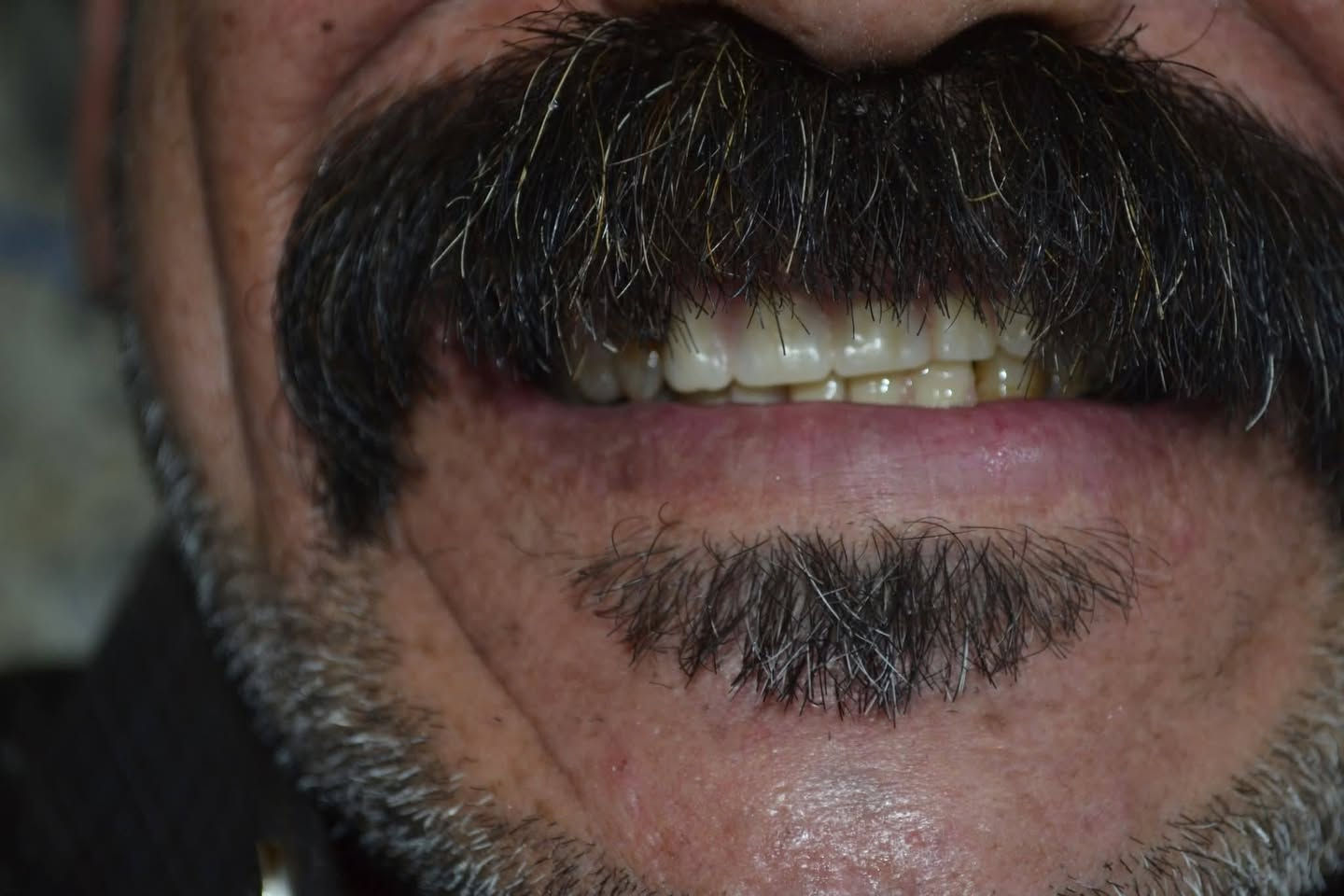 مسابقه -مسابقه- مسابقه 

الكثر شخص متفاعل بعيادتنا يفوز ويانا
شروط المسابقه كلش سهله

1-لايك
2-اكثر شخص يسوي تاكات للاصدقاء
ومتفاعل بلحساب
3-مشاركت المنشور باكثر م̷ـــِْن كروب
4-متابعة الحساب 

الجوائز 🎁🎁🎁🎁

1-تنظيف vip
2-تقويم اسنان
3-تغليف اسنان زاركون 
4-حشوة تجميلية

يتم علان الفائز اول يوم العيد 

المكان/ حي 17 الشارع العام لمكتبة المهندس مجاور لمدرسة المشاعل
للحجز والاستفسار/ ***********

هاي الحاله طقم اسنان متحرك في عيادتنا لمراجع كان يعاني من تقدم في الفك الاسفل ومشاكل في الأطباق 
وهاية النتيجة النهائية بعد تصحيح الاطباق 🔥
