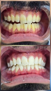 تبييض الأسنان بالليزر 🦷 عياده الاسكندريه لطب وتجميل الاسنان  العنوان/ ...