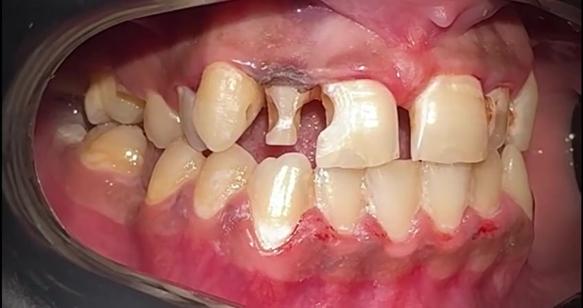 تسوسات الاسنان الامامية, معالجة الاسنان, البناء بالحشوة الضوئية.

عيادة د.عمار عزيز لطيف 👨‍⚕️💗
بغداد / رحمانية الشعله / عمارة الوليد 
للإستفسار الاتصال على 
***********
***********
#عيادة#اسنان
