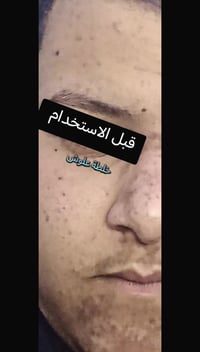 تبييض قوي • خلال ٤ أيام • معالجة الحبوب