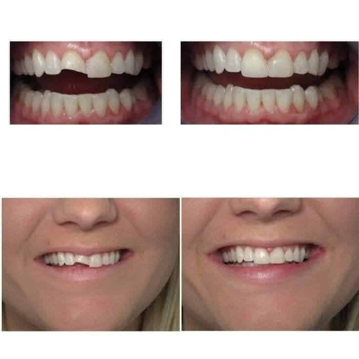 #خدمات_علاجيه_مجانيه_لطب_الفم_والاسنان
●  عيادة الاطفال 
تقويم للاطفال 
قلع الاسنان للاطفال
جلسة فلورايد لتعزيز وتقوية السن من التسوس
حشوات للاطفال 
●  جراحة الوجه والفكين 
قلع الأسنان والجذور التالفة 
معاينة كامله للفم 
قلع الاسنان جراحيا 
●صناعة الاسنان 
تعويض الاسنان المفقودة جزئيا اوكليا بطقم متحرك 
●تنظيف الاسنان وعلاج امراض اللثه 
●حشوات ضوئيه للاسنان 
الموقع حي النقيب شارع النهر 
علما ان العمل تحت اشراف اطباء اختصاص للحجز والاستفسار مراسلتي خاص او عبر الاتصال ع رقم ع واتساب ***********
