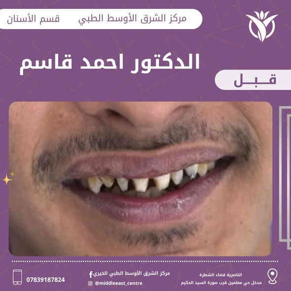 حالة علاجية من مركزنا 
للدكتور احمد قاسم 

شنو رايكم بشكل الابتسامة بعد العلاج 😍

🕠أوقات دوام المركز خلال أيام الأسبوع
🕠صباحاً من الساعه 8:00 الى الساعه 12:00ظهراً
🕠مساءً من الساعه 2:30 ظهراً الى الساعه 9:00ليلاً

📍العنوان الشطرة مدخل حي المعلمين قرب صورة السيد الحكيم 

📞الأستفسار أكثر الإتصال على الرقم التالي ***********⁩
