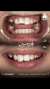 معالجة سن امامي • حشوات تجميلية • تلحية الزاب