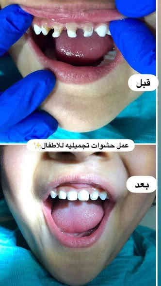 السلام عليكم 
منو محتاج 
قلع 
عيادة اطفال: (قلع ،حشوات ،تنظيف الاسنان) 
تقويم 
حشوات تجميلية ومعدنية
تعويض الاسنان المفقودة بطقم متحرك
فاقد اسنان فك كامل او احدى الفكين 
تنظيف الاسنان من التكلسات
يتواصل وياي 
العمل مجاني بغداد الكراده شارع 52عيادات جامعة ارووك ***********وتساب
