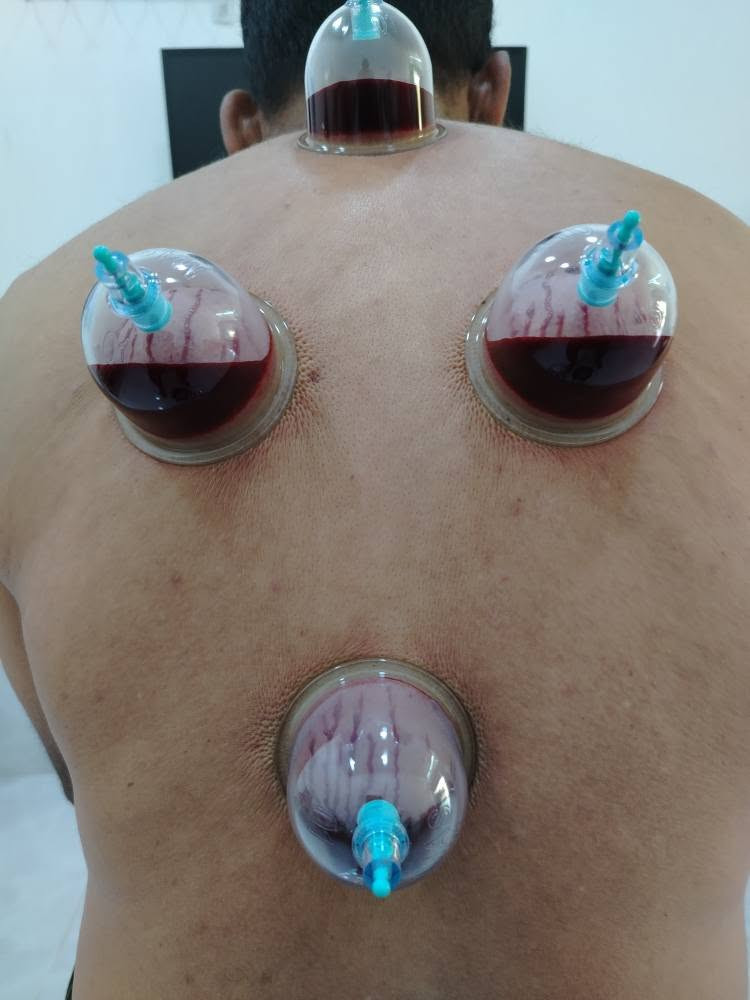 يتكون دم الحجامة (المستخرج عبر الحجامة ) من سوائل وتركيبات تختلف عن الدم الوريدي العادي.
 يحتوي في الغالب على كريات دم حمراء هرمة، ونسبة عالية من السموم والمعادن الثقيلة، إضافة إلى أخلاط وترسبات ضارة تسعى الحجامة لإخراجها من الجسم.إليك التفاصيل العلمية لمكونات هذا الدم وخصائصه:كريات الدم الحمراء: يتركز في دم الحجامة عدد كبير من كريات الدم الحمراء التالفة أو "الهرمة" التي انتهى عمرها الافتراضي وتكون محملة بالشوائب مختصة هذا ما وجده العلماء في الدم المستخرج بعد الحجامة  كما يحمل نسبة هيموغلوبين مركزة.السموم ومخلفات الأيض: أثبتت الأبحاث أن دماء الحجامة تحتوي على مستويات أعلى بكثير من السموم، مثل حمض اليوريك، والأمونيا، واليوريا مختصة هذا ما وجده العلماء في الدم المستخرج بعد الحجامة والتي قد تصل لسبعة أضعاف الحد الطبيعي الموجود في الدم الوريدي.المعادن الثقيلة: يساعد هذا الإجراء في التخلص من المعادن الثقيلة والضارة المترسبة في الأنسجة، وتخفيف مستويات بعضها (مثل الكادميوم والألومنيوم) في الجسم تأثير العلاج بالحجامة الرطبة على مستويات بعض المعادن الثقيلة في الدم.خلايا الدم البيضاء: يلاحظ أن نسبة خلايا الدم البيضاء في دم الحجامة أقل بكثير منها في الدم الطبيعي، مما يعني توفير حماية أكبر للخلايا المناعية لتبقى نشطة وتعمل بكفاءة داخل الجسم مختصة هذا ما وجده العلماء في الدم المستخرج بعد الحجامة الرمادي, الأنبار


**إذا كنت صاحب هذا الإعلان وتريد حذفه لأي سبب، رجاءا أرسل رسالة إلى الدعم الفني**