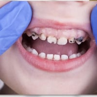 اسنان اطفال • قلع اسنان • البصرة