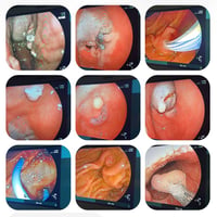 مناظير علاجية • EMR هجين • ERCP دعامة