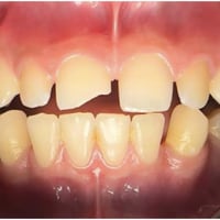 عيادات جامعة الكفيل • خدمات أسنان مجانية • قالب أسنان متحرك