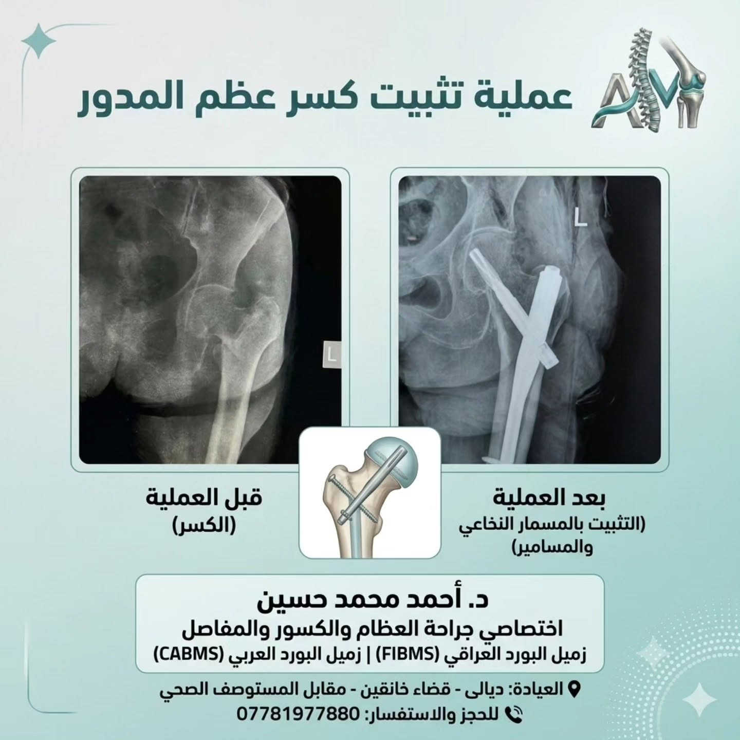الدكتور احمد محمد حسين 
بورد في جراحة العظام والمفاصل والكسور 
للاستفسار على الرقم 📞 ***********
