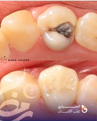إعادة تأهيل • حشوات مختبرية • المسيب