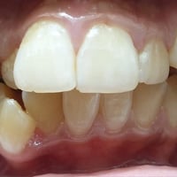 رفع التقويم بعد ترتيب وتعديل الاسنان للفكين طبيب الاسنان الاختصاص د.عم...