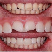 علاج أسنان مجاناً (حشوات ضوئية للكبار والصغار // تنظيف اسنان // قلع جذ...