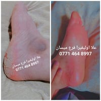 ميسان • كريم مرمم • جوراب طبي