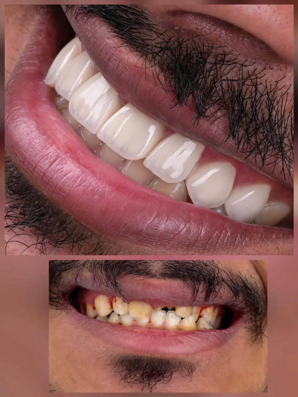مركز ماسة الحسينية التخصصي لطب وجراحة الفم والأسنان 

أسنانك تستحق الدلال.. لا تهملها! 🦷💎

لأن الابتسامة هي أول شي يلفت الانتباه، اهتمامك بصحة أسنانك هو استثمار بنفسك وبصحتك.

📍 الموقع: بغداد - الحسينية - خلف السوق الأول - شارع 20
📱 تواصل معنا الآن: ***********
