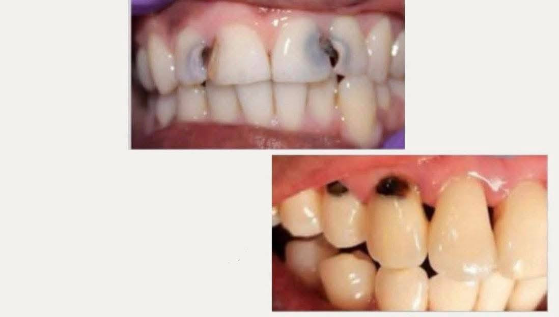 السلام عليكم .
. المحتاج علاج لاسنانه وبشكل مجاني يتواصل ويايه عالخاص
***********على رقم الواتساب. 
 والعلاج يشمل ..
 حشوات ضوئيه 

_قلع الاسنان والجذور التالفه 

تنظيف الاسنان وازالة التكلسات

-عيادة الاطفال التي

 تتضمن(الحشوات-القلع-التنظيف-جلسة فلورايد وقائيه لحماية الاسنان من التسوس 

العنوان الجامعه العراقيه _ الاعظميه
كليه طب الاسنان _قرب المقبرة الملكية

علماً بأن العلاج مجاناً وتحت إشراف أطباء اختصاص
