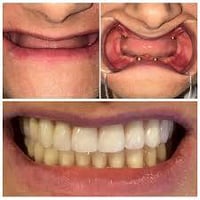 الي محتاج: قلع  تعويض طقم اسنان كامل او شبه كامل  حشوات  تنظيف  العياد...