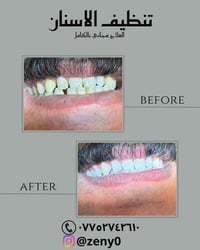 علاج مجاني بالكامل 🕊️ الخدمات المتوفرة : 🕊️فحص الاسنان 🕊️قلع الاسنان ا...