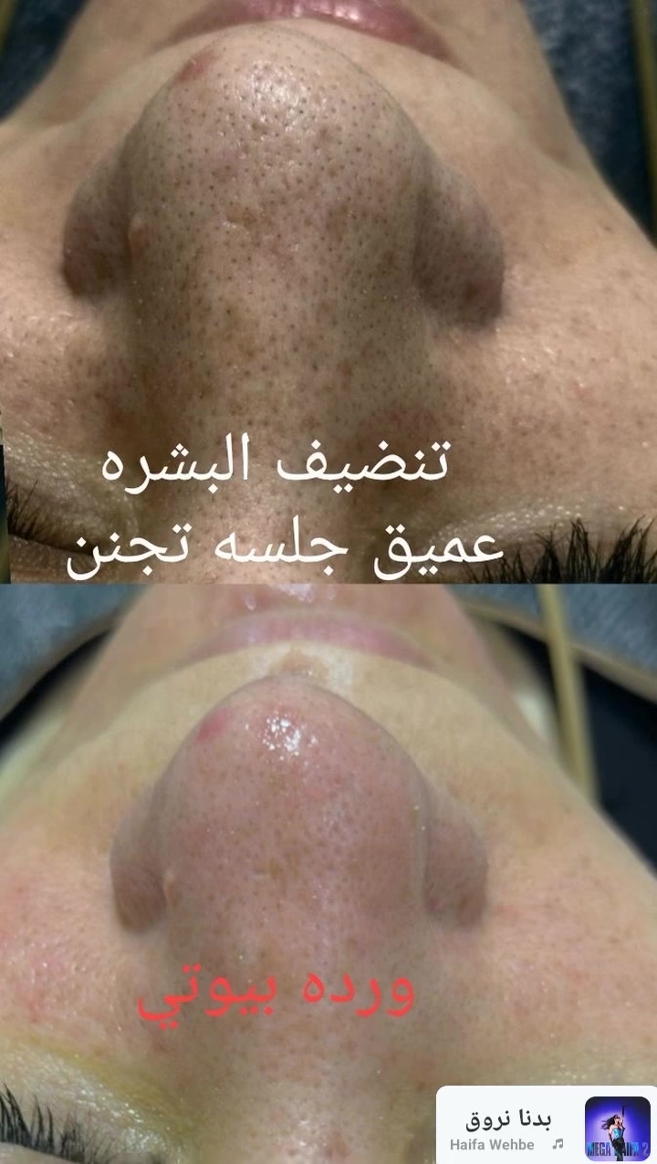 𝒲𝒶𝓇𝒹𝒶 𝐵𝑒𝒶𝓊𝓉𝓎 🎀 
🌷 ورده بيوتي 🌷 
الخطيب الزراعي شارع المولده الحمره شارع عيادات صحتي 
للحجز مراسله الصفحه الرئيسيه 
او مراسله الرقم واتساب ***********
#لايكات #لايك #متابعه #عناية #بشرة #عناية_بالبشرة #اكسبلور  #بشره #حبوب #جميله #العراق #explore #skincaretips #skincare
